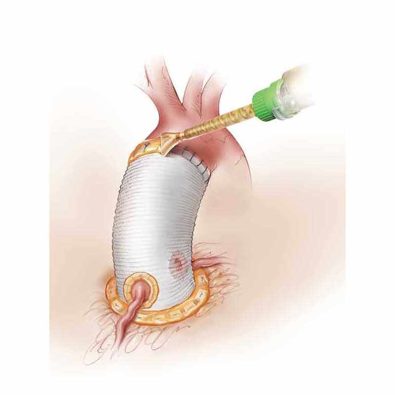 Surgical glue BioGlue Cardiology equipment Tunisia