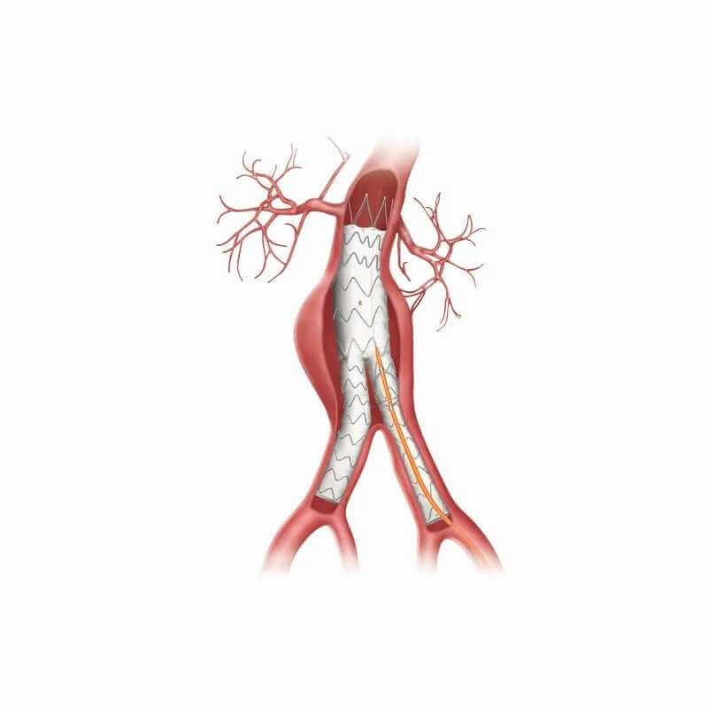 Stent Graft Balloon Catheter Expand Biomedica Tunisia