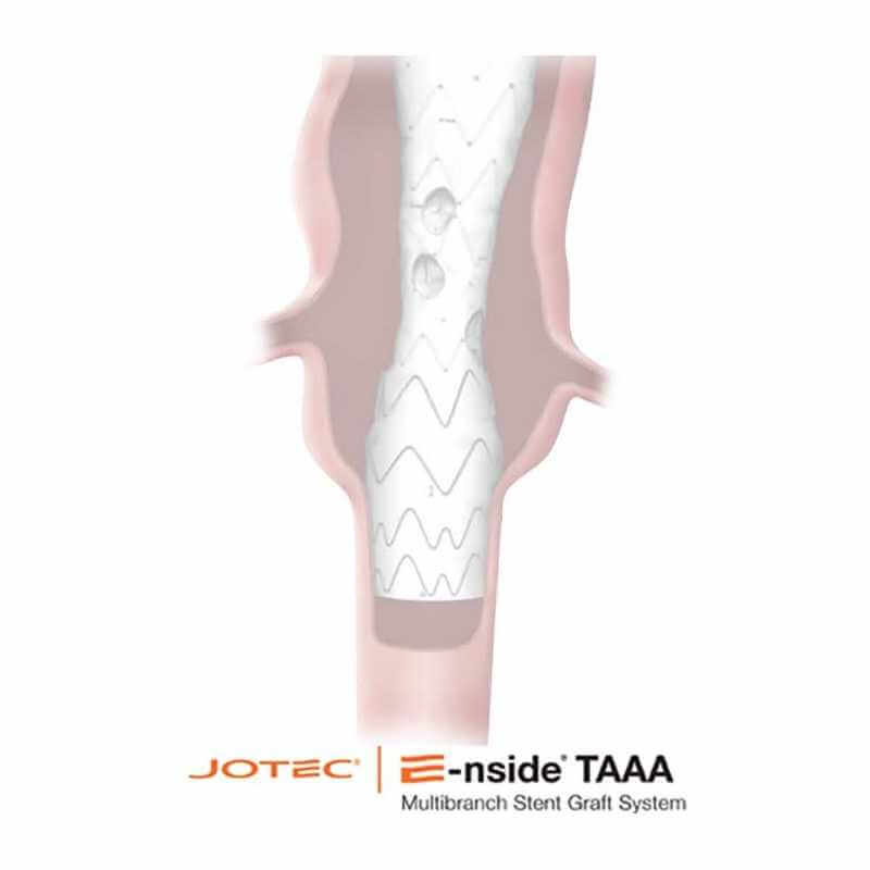 Taaa Incision Endoprothèse thoracoabdominale E-nside TAAA | Tunisie