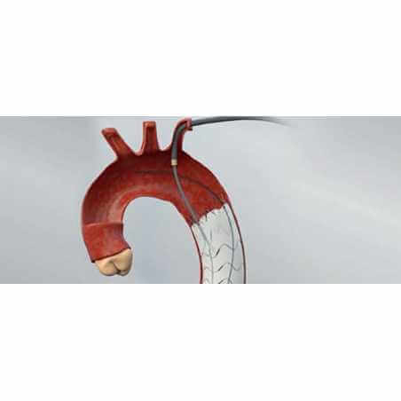 E-nside TAAA Thoracoabdominal Endoprosthesis | Tunisia