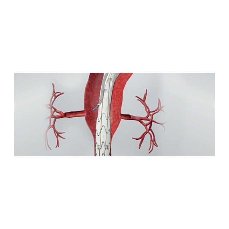 Taaa Incision Endoprothèse thoracoabdominale E-nside TAAA | Tunisie
