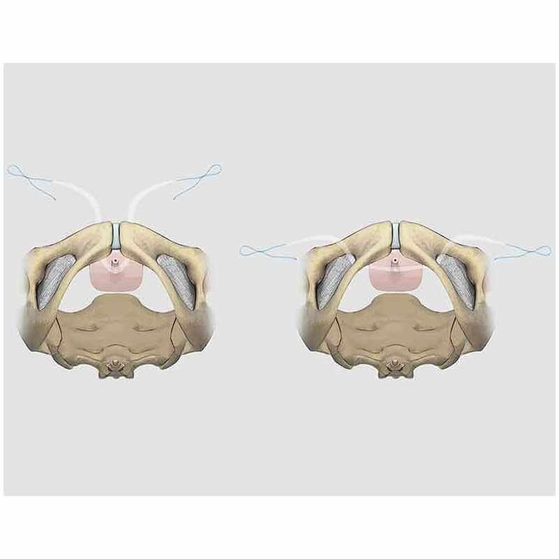 Urinary Incontinence Sling Biomedica Tunisia