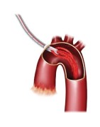 Arterial Cannulas | Biomedica Tunisia