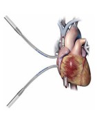 Canules veineuses | Biomedica Tunisie