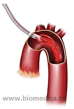 Canule artérielle EOPA 3D