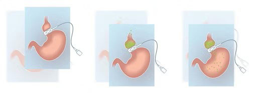 HELIOGAST HAGE Gastric Band